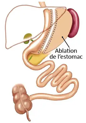 Ma chirurgie bariatrique