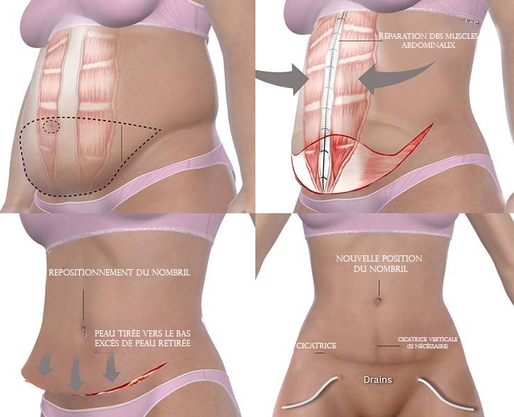 Abdominoplastie
